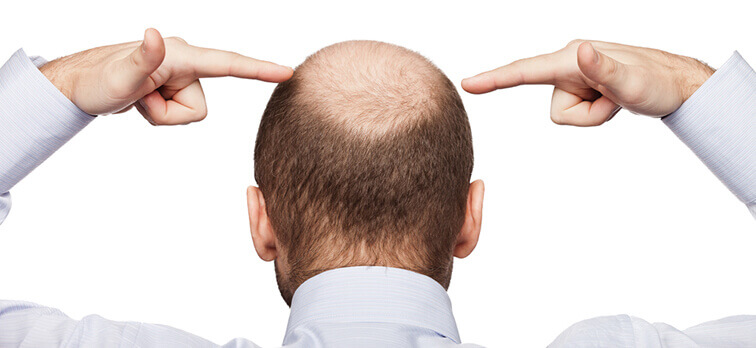 Hatalı saç ektirmenin kişiye vereceği zararlar nelerdir?