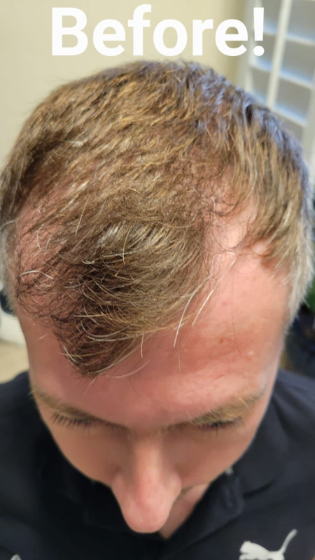 Shedding After Hair Transplant; Is It Normal? | Kaayakalp