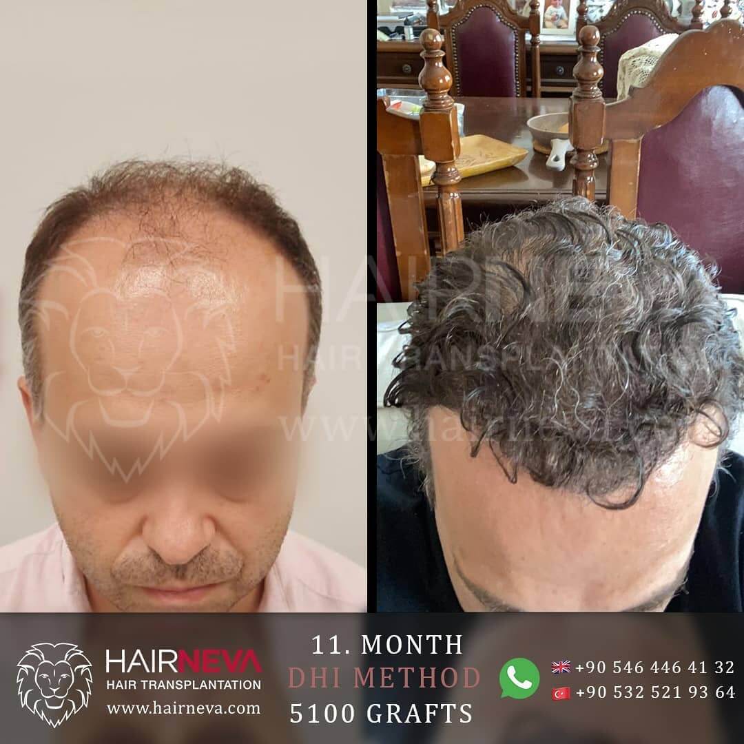 DHI Hair Transplant Turkey - Advanced Hair Transplant 2023