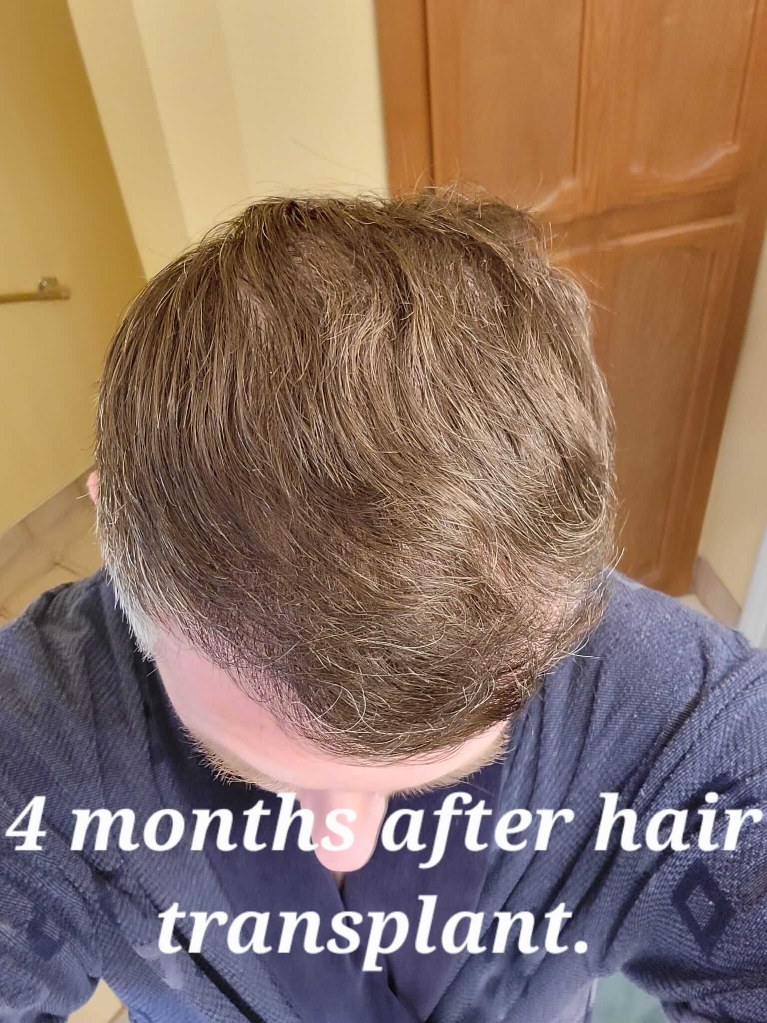 Hair Transplant After 4 month