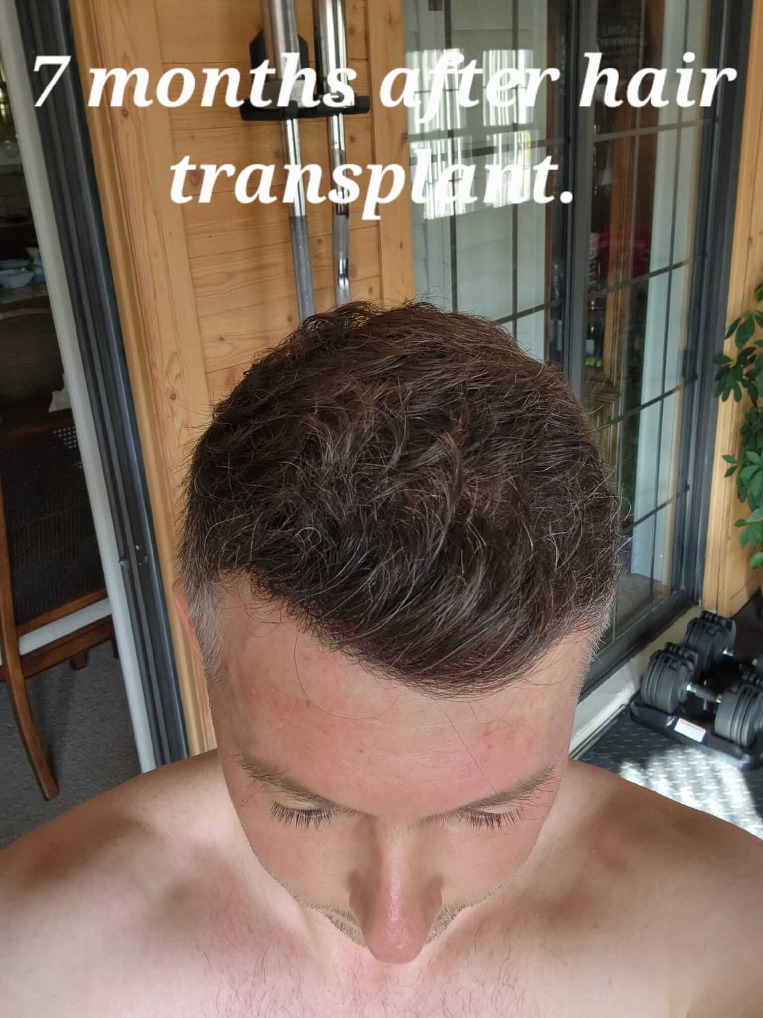 Hair Transplant After 7month