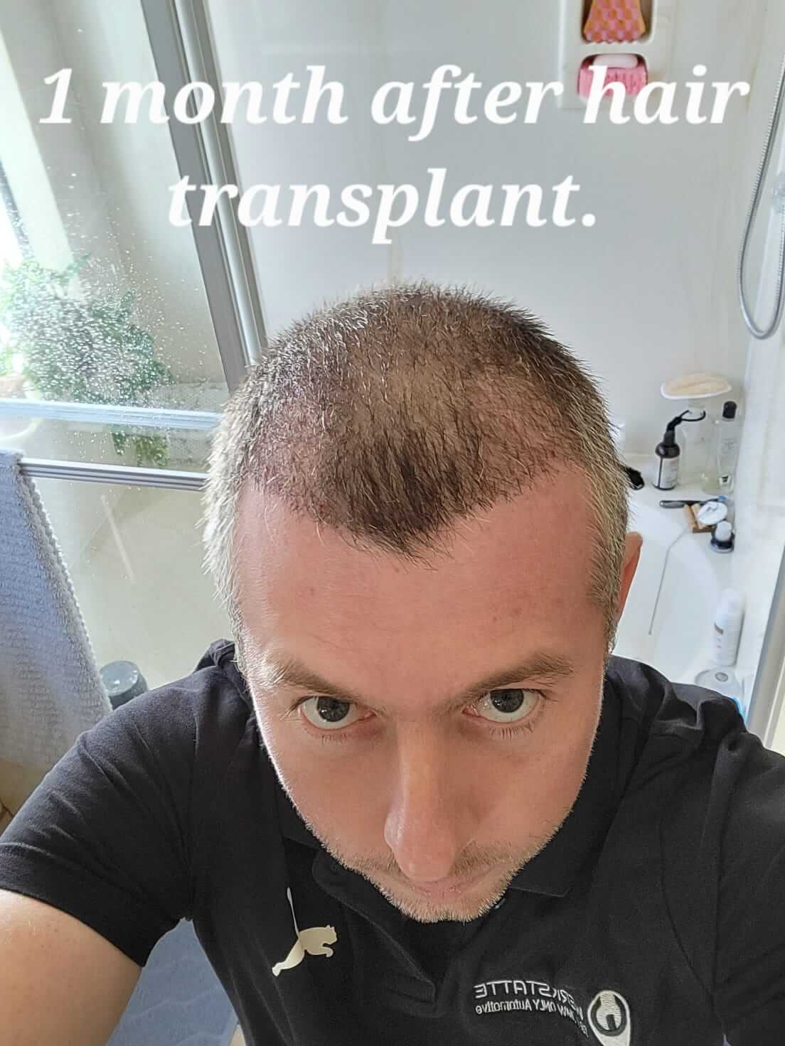 Hair Transplant Turkey Before After - Hairneva
