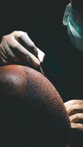 Optimizing Hair Transplant Results: Understanding the Impact of Graft Number