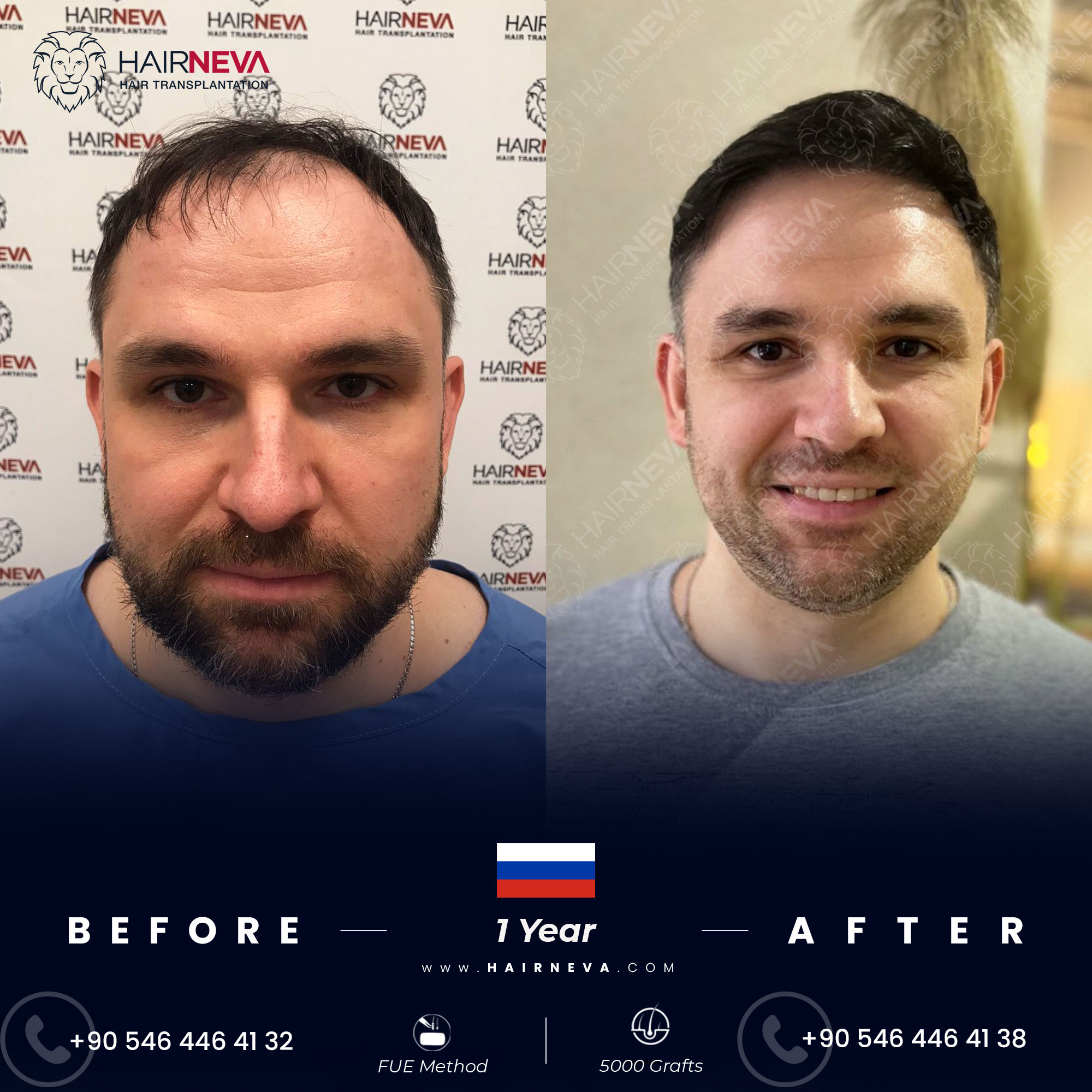 Affordable FUE Hair Transplant Turkey Offers Quality Care Affordable FUE Hair Transplant Turkey Offers Quality Care