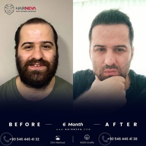 body hair transplantation beard transplatation 