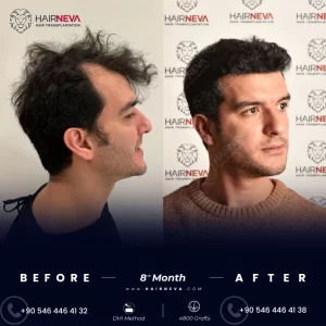 hair transplant dhi technique fue technique best method 