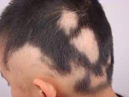 alopecia