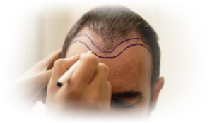 hair loss
