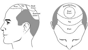 hair transplantation