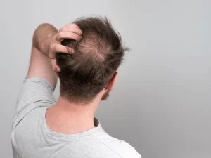 hair loss