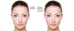 forehead reduction