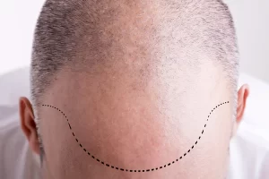 hairline design
