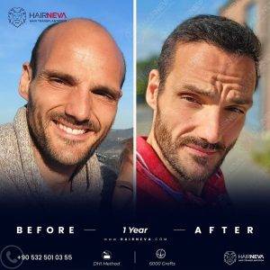 hair transplant