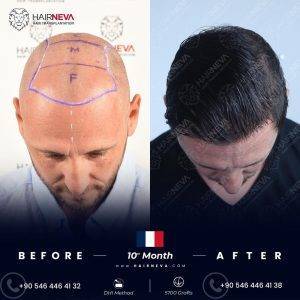Best Hair Transplant Clinics in Istanbul