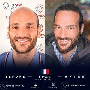 cost hair transplant before and after