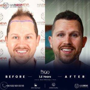 Hair Transplant in Turkey