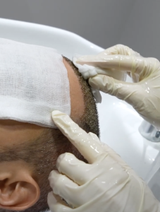 Hair transplant recovery process