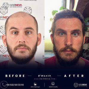 Best hair transplant clinics in Turkey