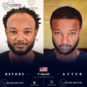 ethnic hair transplant