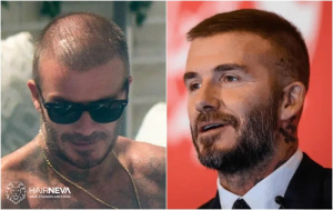 hair transplants