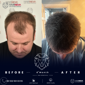 Turkey Hair Transplant Package