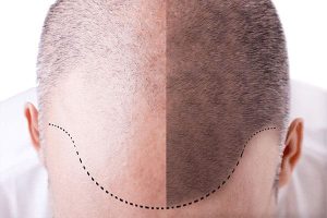 hair transplant recovery process