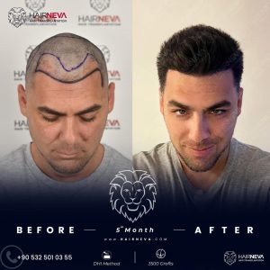 best hair transplant in istanbul