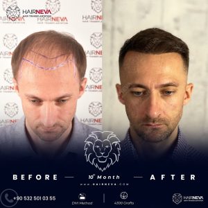 hair transplant clinic in Turkey