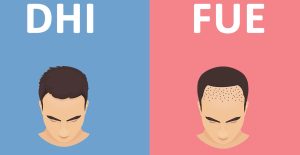 FUE vs. DHI Hair Transplant