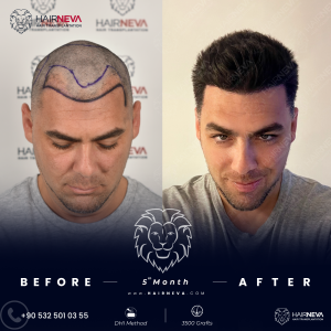 Hair Transplant Turkey vs USA