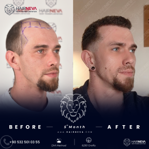 Hair Transplant Cost in Istanbul