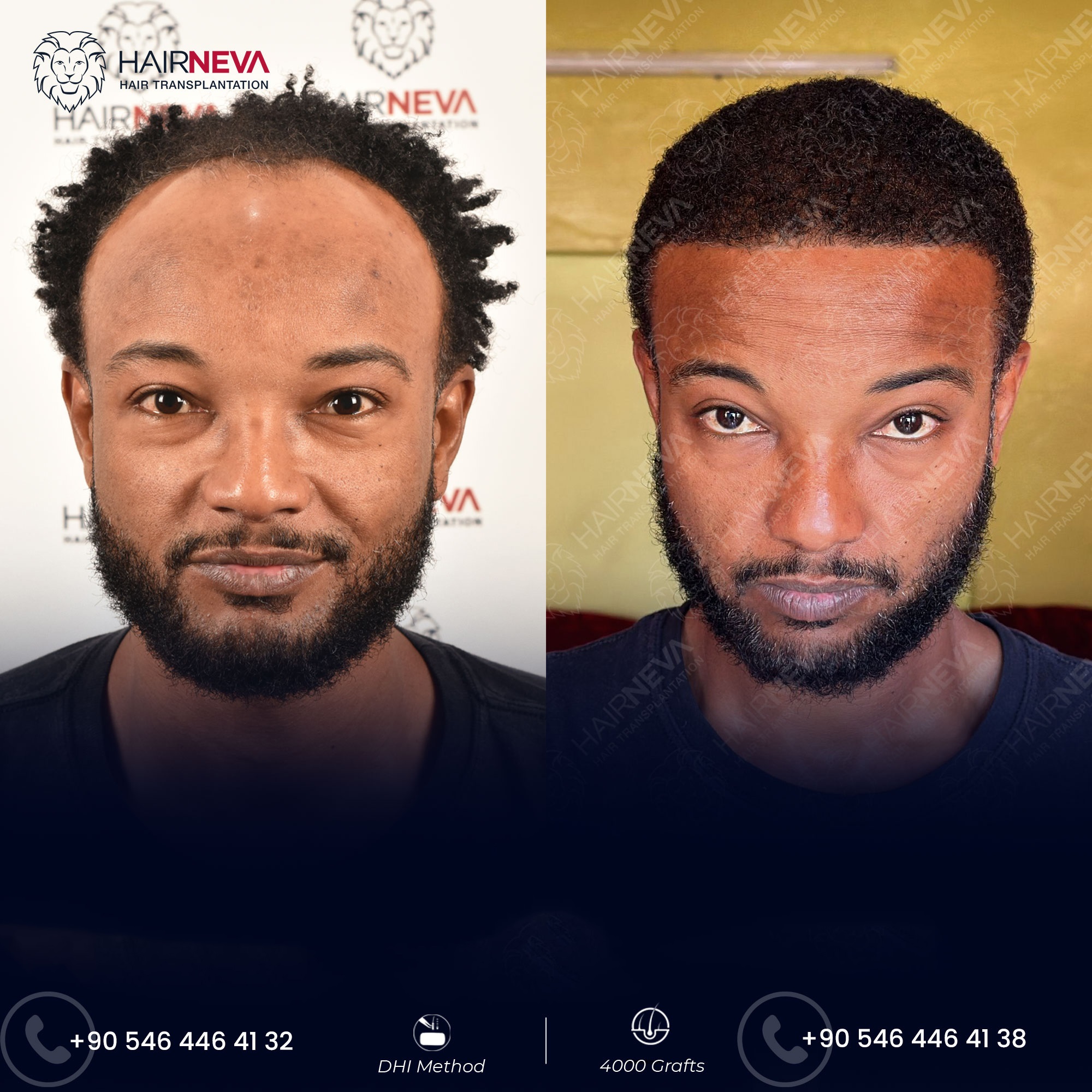 Afro Hair Transplant in Turkey