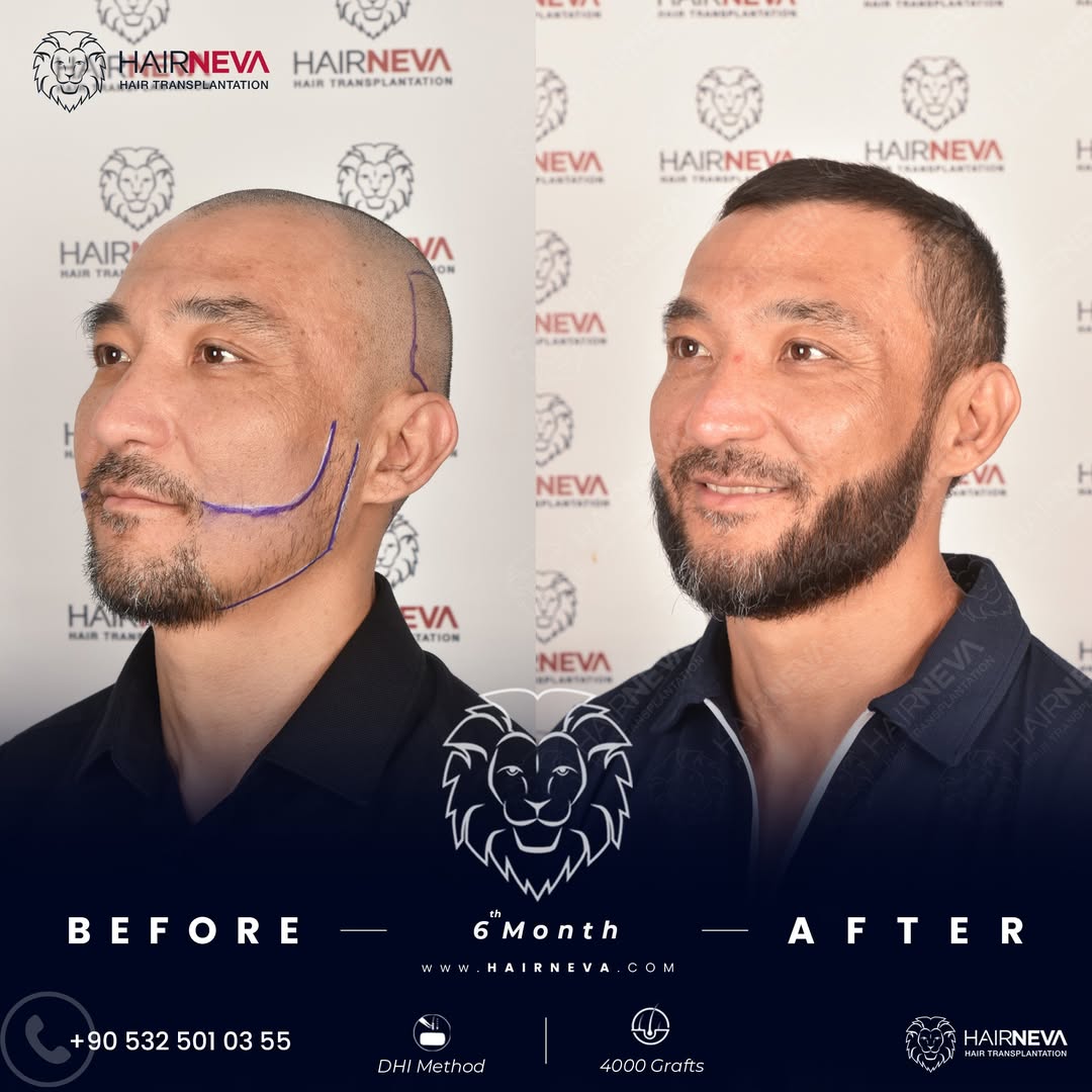 Beard Transplant in Turkey