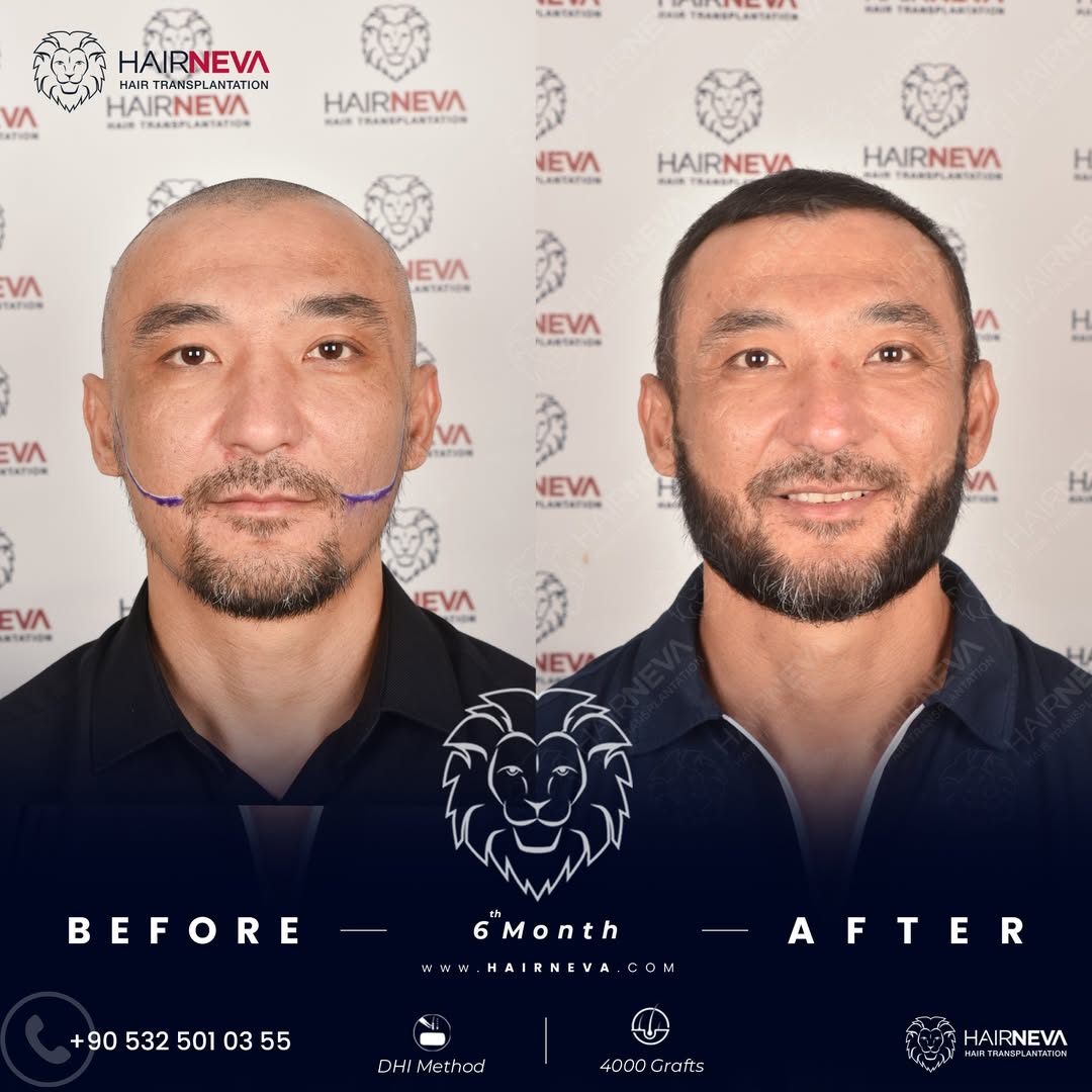 Beard Transplant in Turkey 3