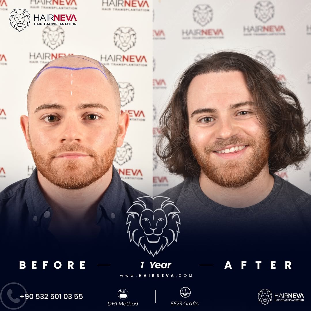 DHI Hair Transplant in Turkey
