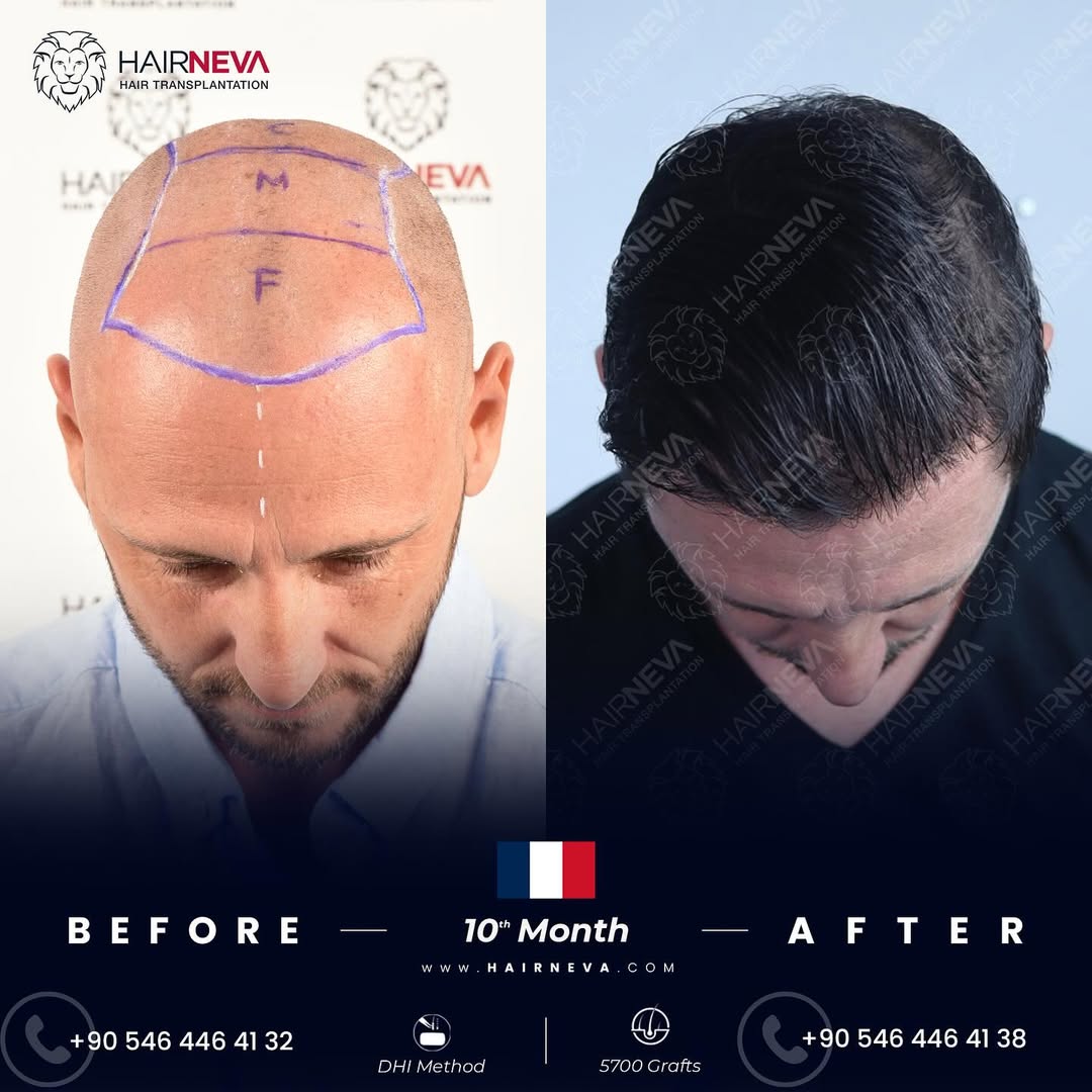 DHI Hair Transplant in Turkey