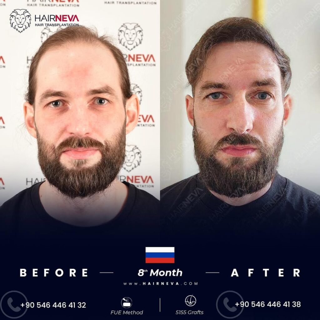 Fue Hair Transplant in Turkey