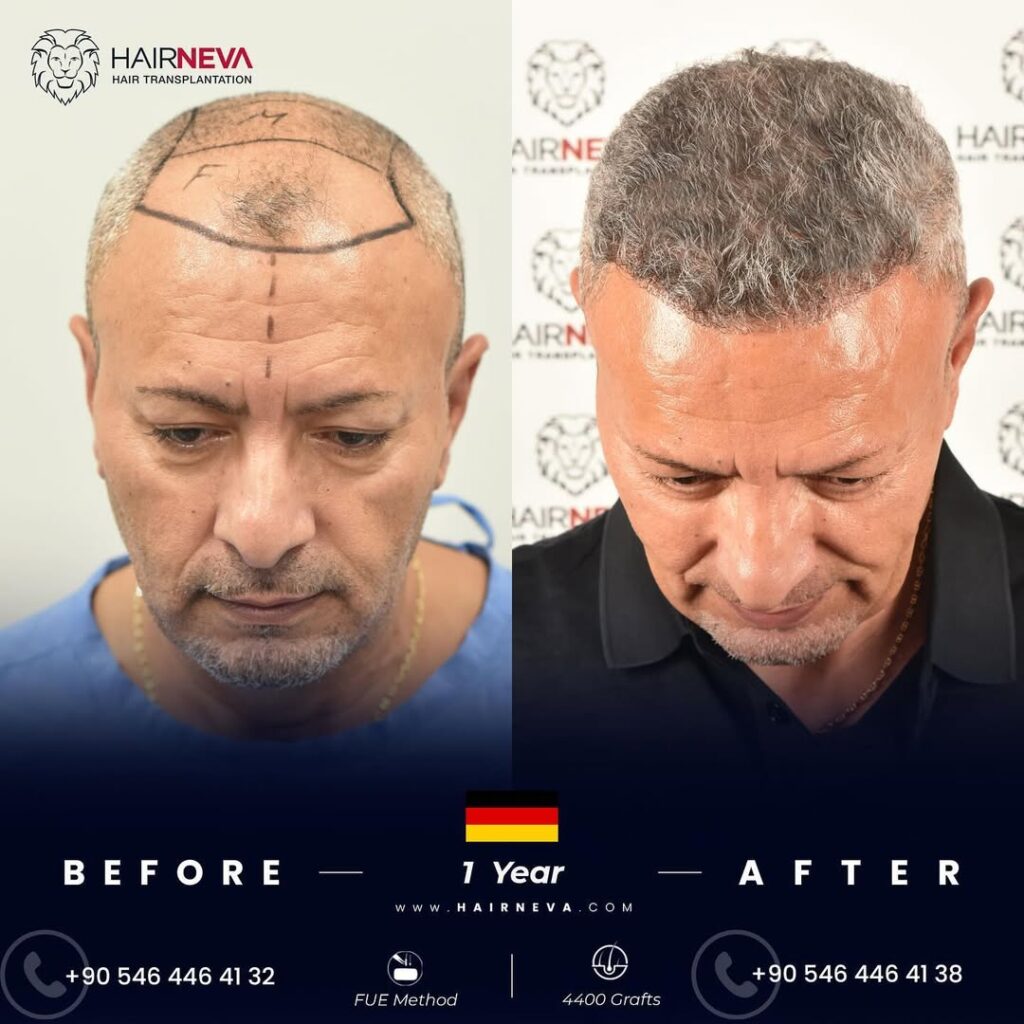 Fue Hair Transplant in Turkey