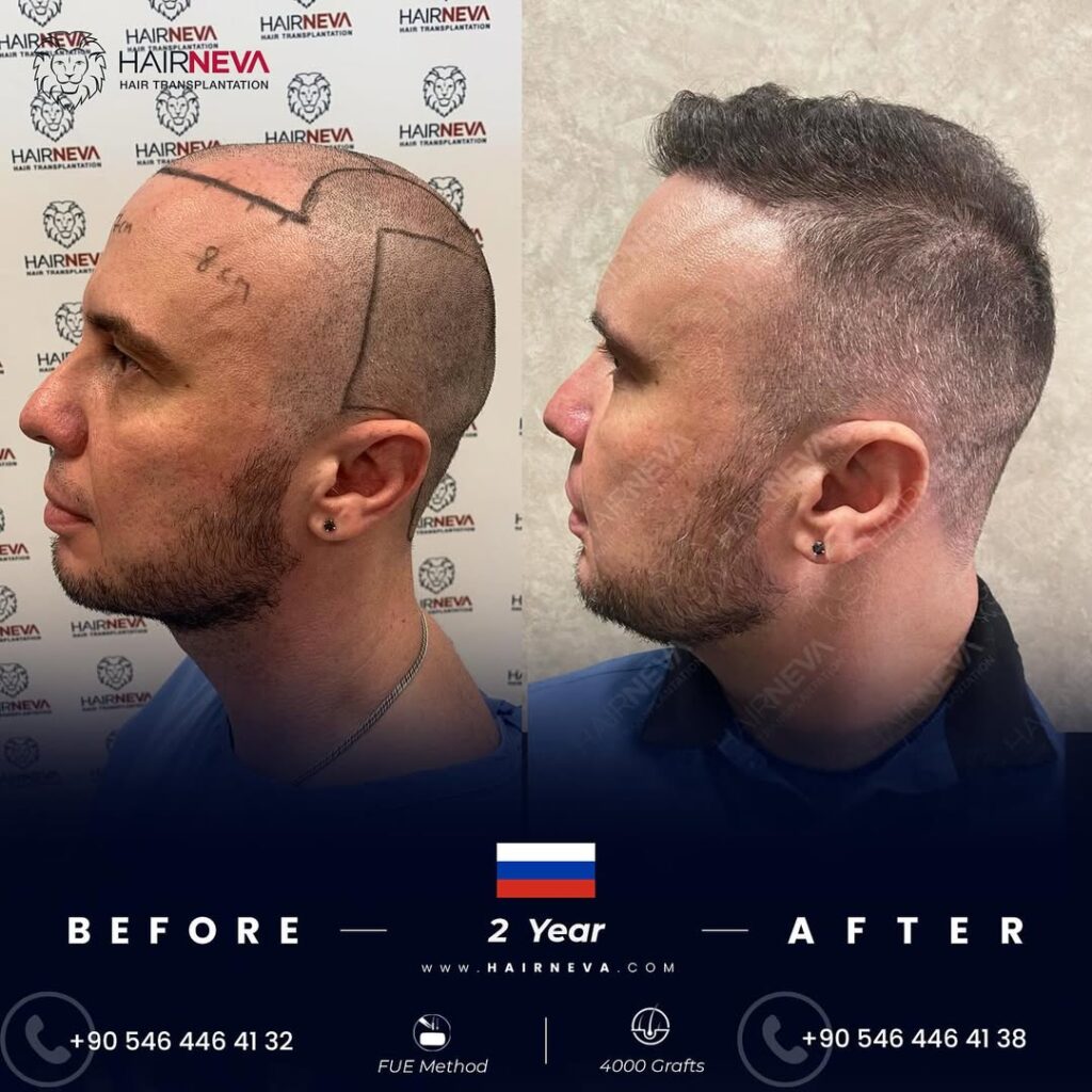 Fue Hair Transplant in Turkey