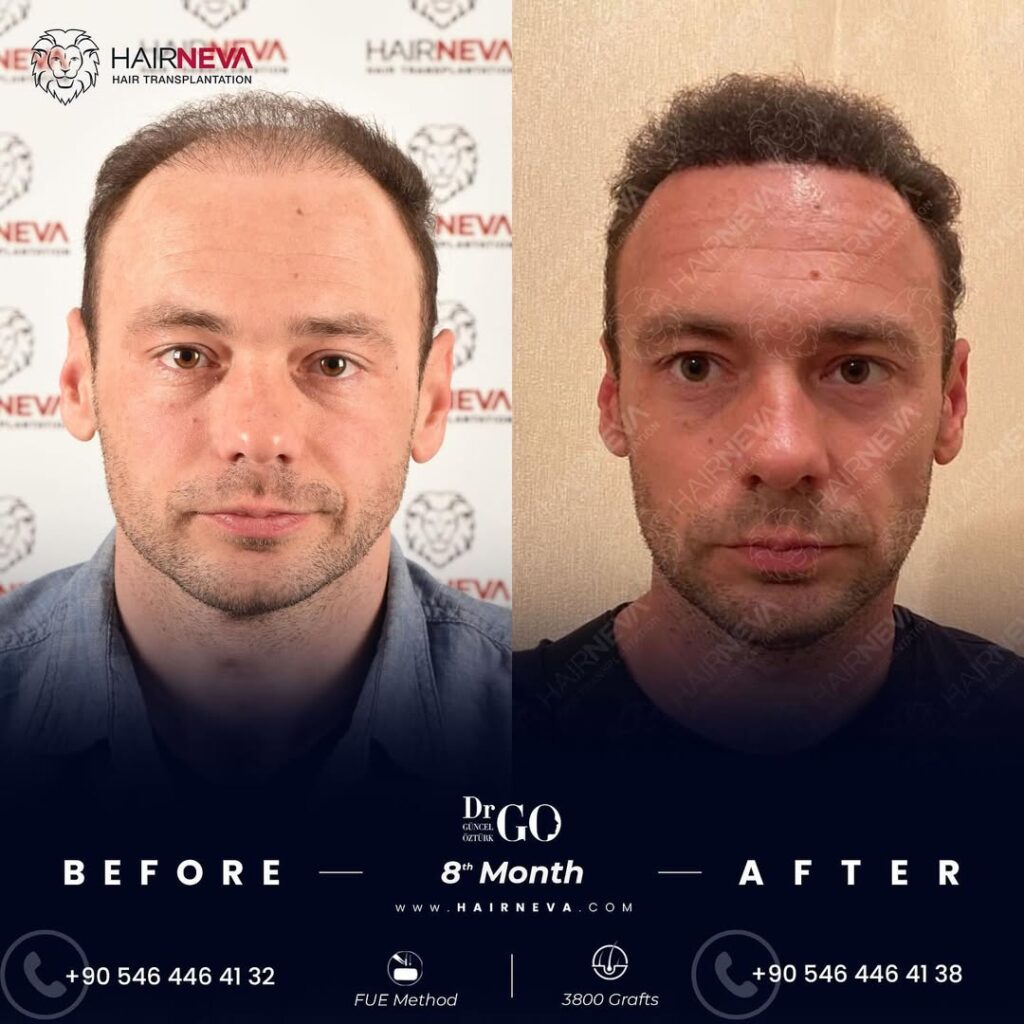 Fue Hair Transplant in Turkey