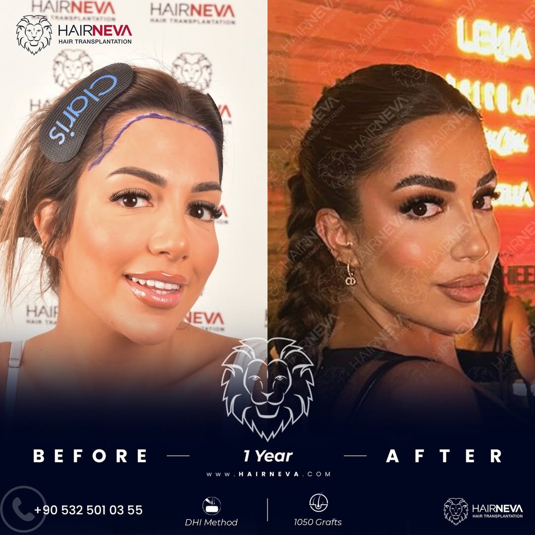 Women Hair Transplant in Turkey