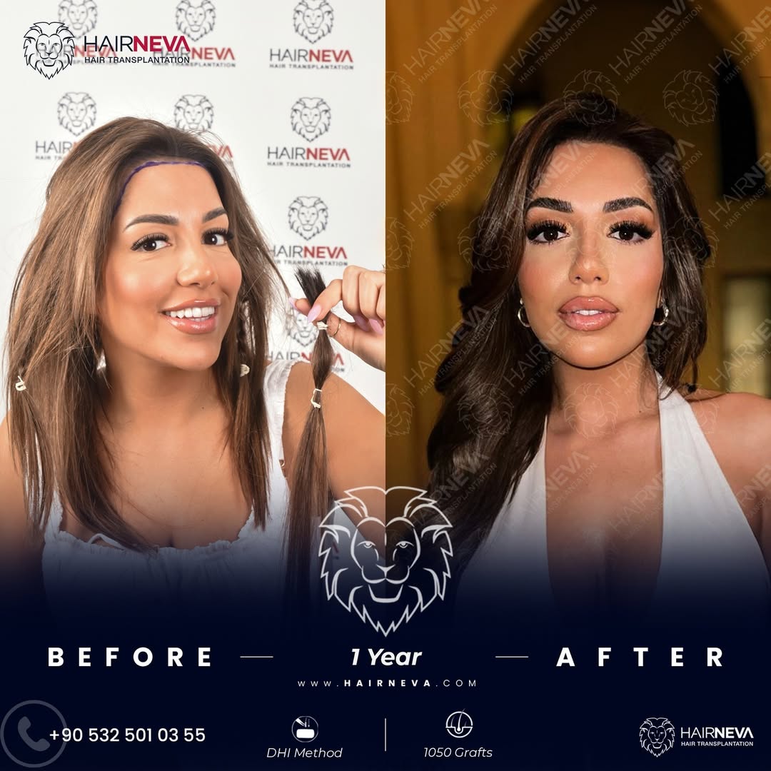 Women Hair Transplant in Turkey