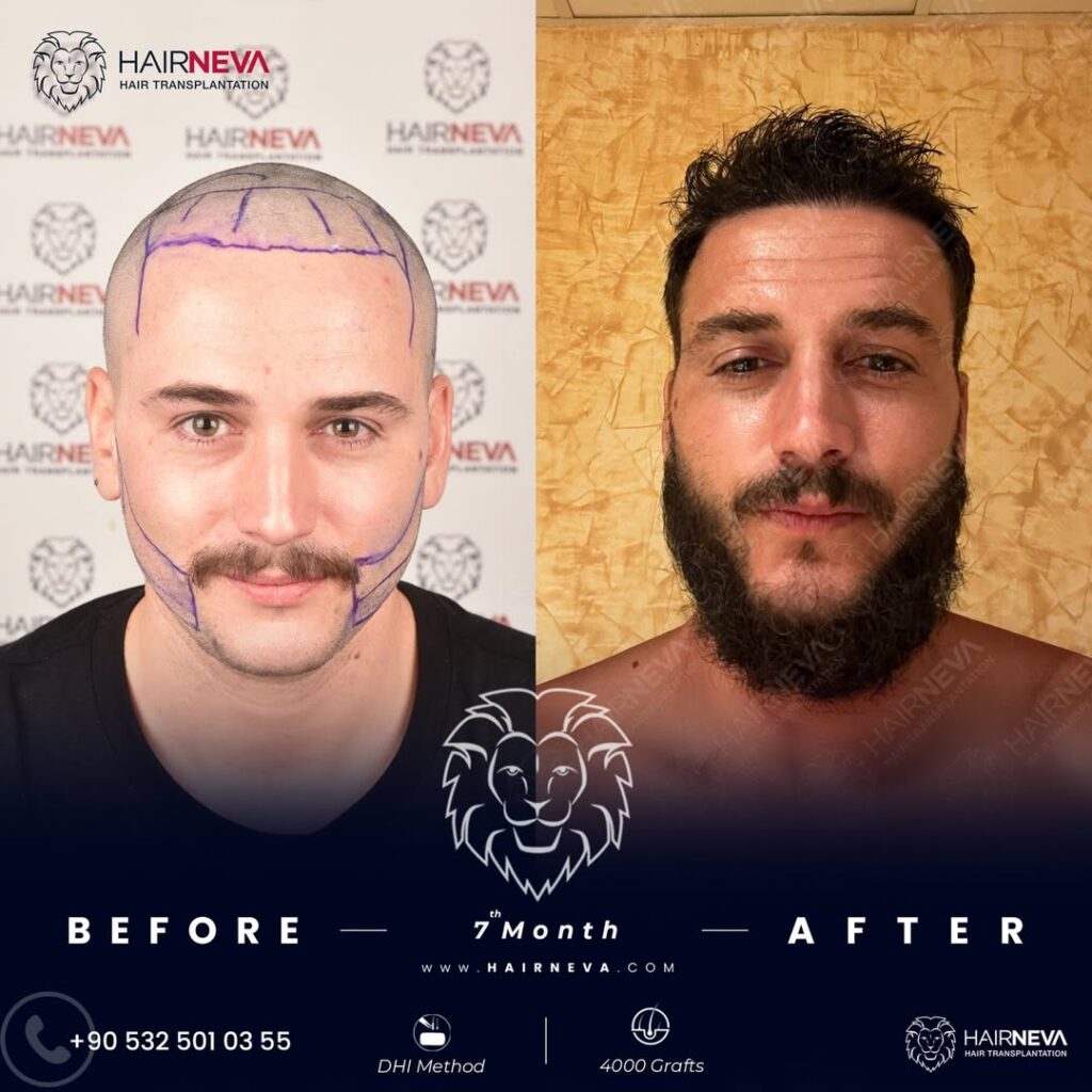 hair transplant
