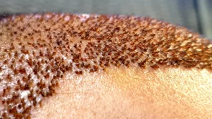 After Hair Transplant Scabs