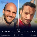 Haartransplantation ohne Rasur in der Türkei