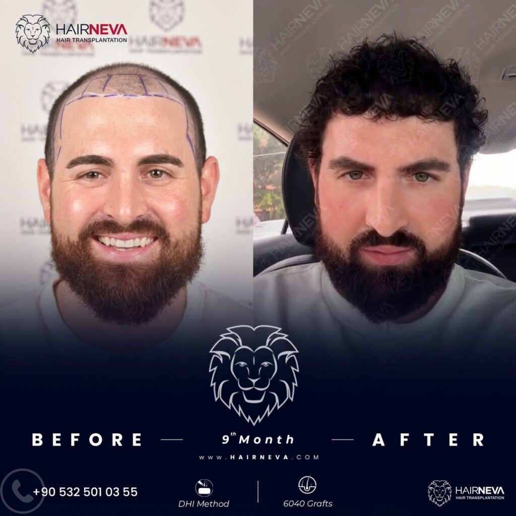Trasplante capilar DHI en Turquía 4 Trasplante capilar DHI en Turquía