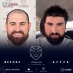 Haartransplantation ohne Rasur in der Türkei