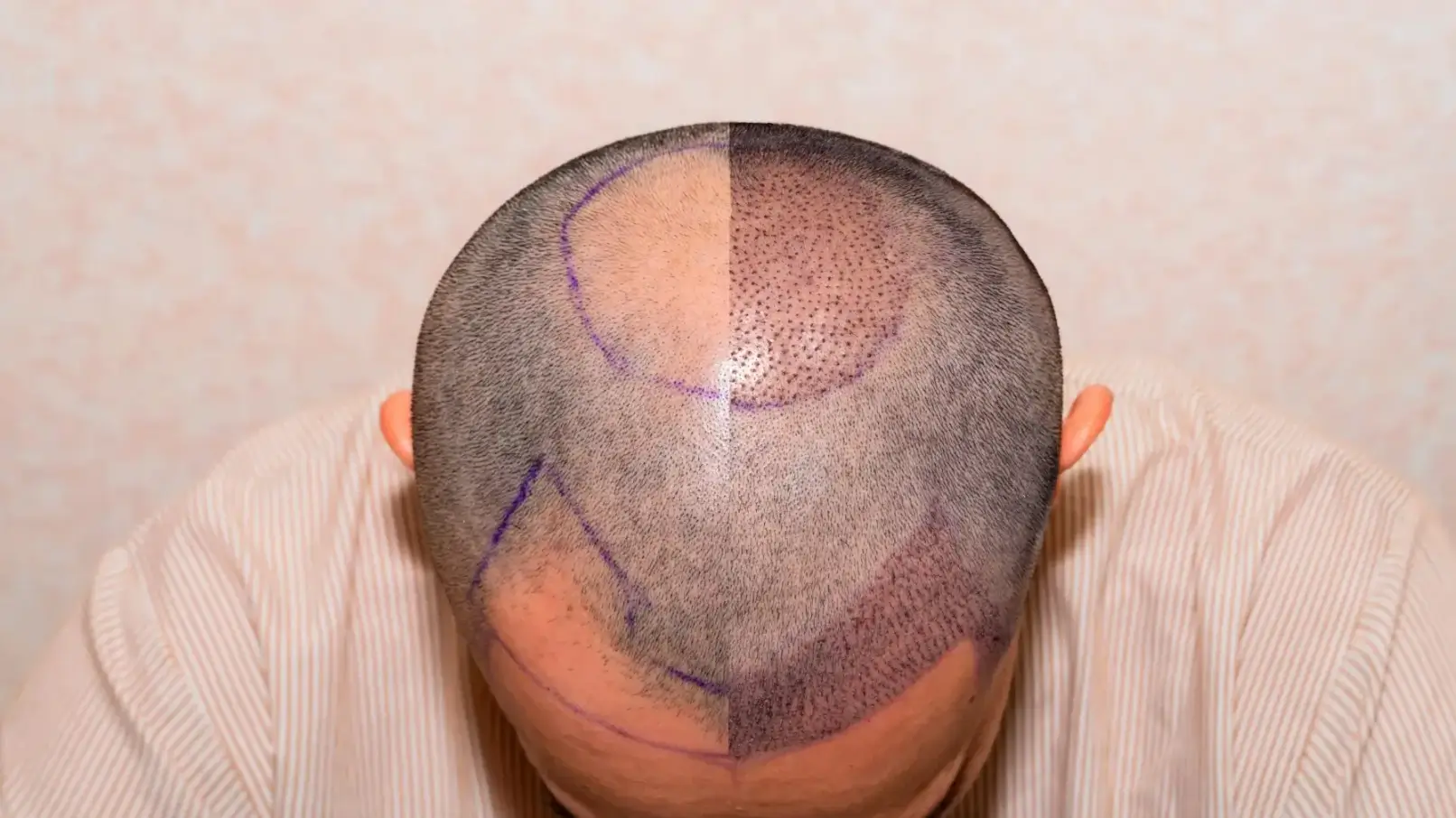 DHI Hair Transplant in Turkey