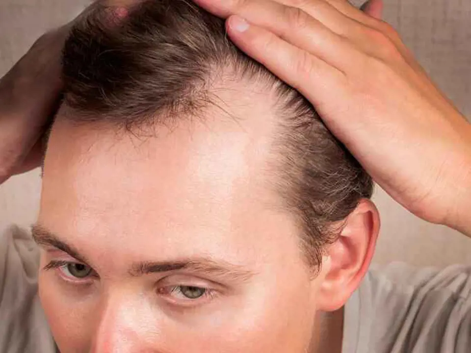 Erkek Tipi Saç Dökülmesi (Androgenetik Alopesi) Nedir?