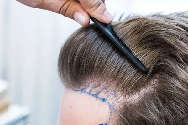 Transplante de Cabello FUE en Turquía